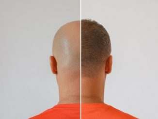 Hair transplant clinics