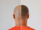 Hair transplant clinics