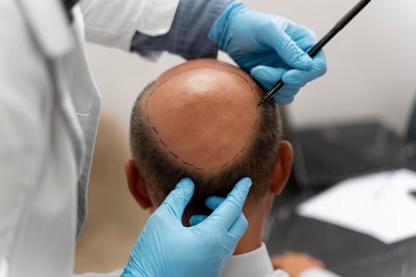 Hair transplant