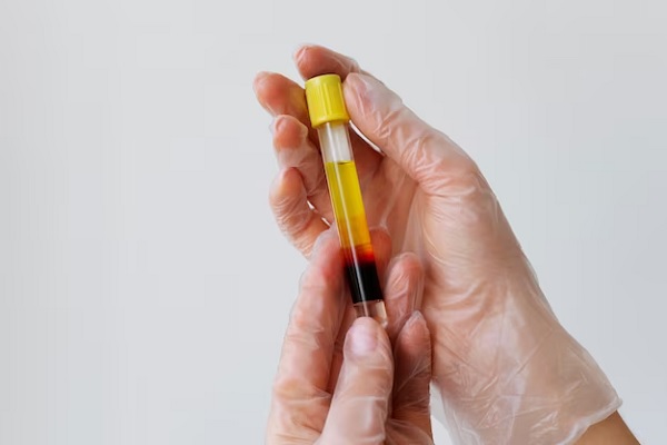 PRP Treatment 