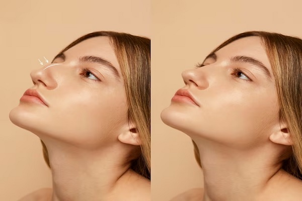 Rhinoplasty