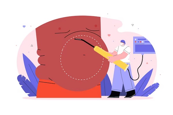 cartoon of a doctor performing gastric sleeve surgery