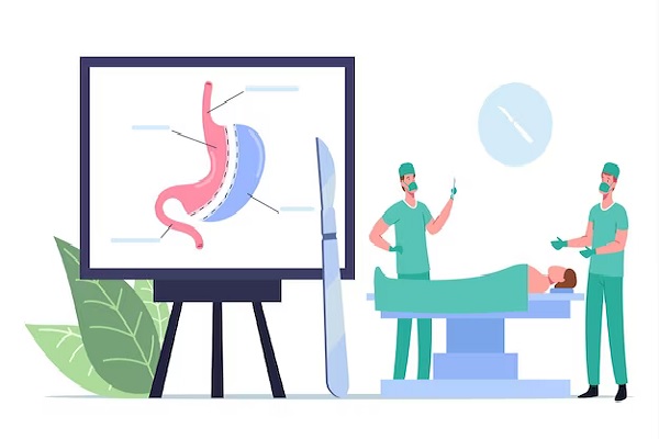 a doctor showing a slide where the stomach is cut during a gastric sleeve surgery