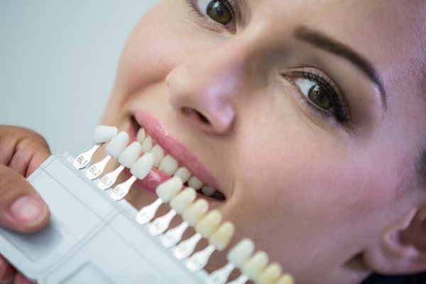 Types of Dental Veneers