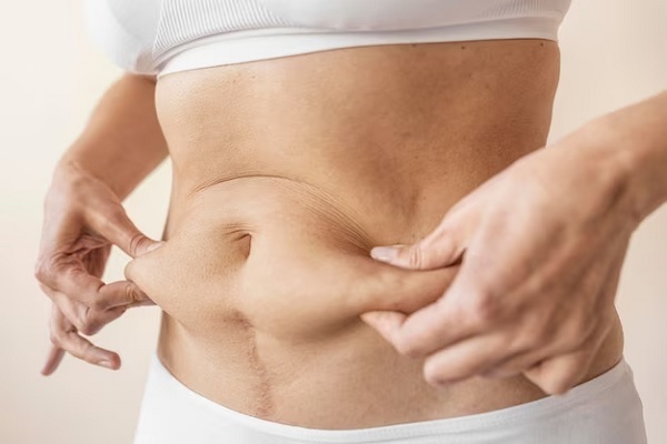 abdominoplasty