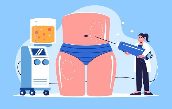 liposuction clinics in Istanbul Turkey