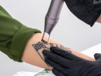 Best Tattoo Removal Centers In Istanbul