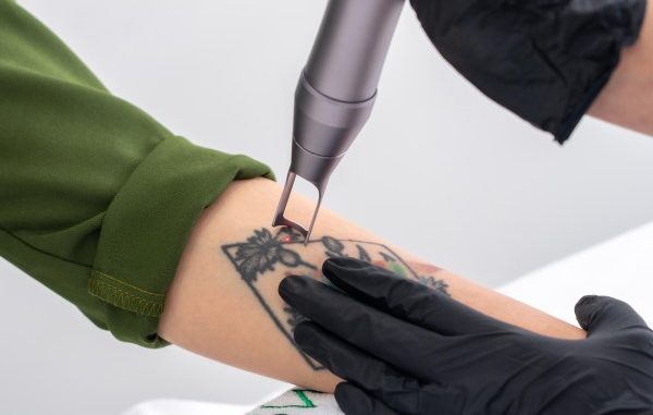 Best Tattoo Removal Centers In Istanbul
